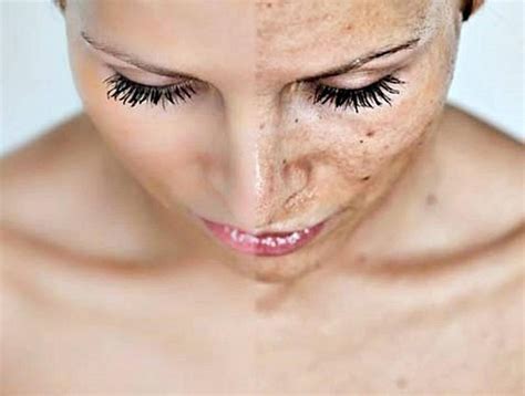 5 Tricks To Get Rid Of Dark Spots And Hyperpigmentation Musely