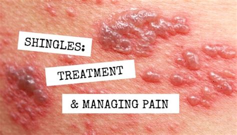 Shingles Treatment And Managing Pain Wcei