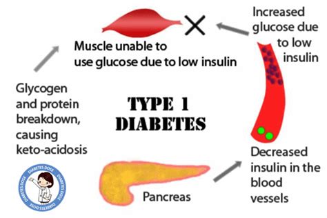 Treatment And Prevention Of Diabetes Type 1 Diabeteswalls