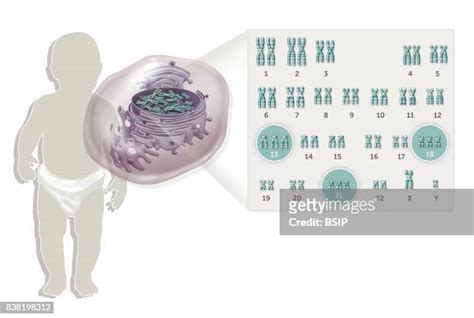 Trisomy Of Chromosome 21 Photos And Premium High Res Pictures Getty Images