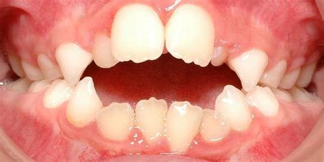 la maloclusion abad  antolin clinica de ortodoncia