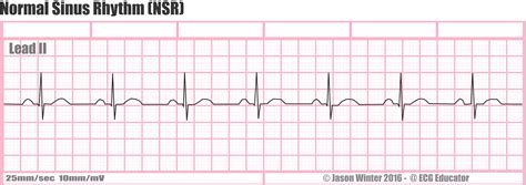 How To Read An Ekg Strip Lecture Electrocardiography