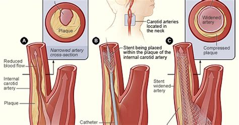 When the carotid arteries get dilated or distended the carotidynia occurs. What are the treatments for carotid artery blockage? | eHow UK