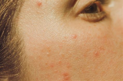 You Might Not Know All The Different Types Of Acne Offhand But You
