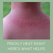 Prickly Heat Rash - Causes, Prevention & Treatment - Odylique