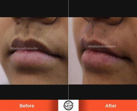 Real Results Before And After Photos Of Upper Lip Laser Hair Reduction Treatment