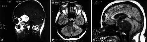 A C Illustrative Cases Showing Skull Base Meningiomas With Different