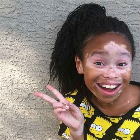 Meet The 10 Year Old Girl With Vitiligo Whos Making Waves As A Model