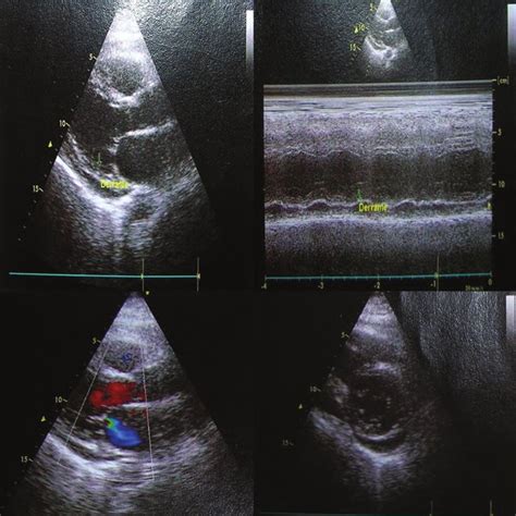 Portion Of Biopsied Scalene Lymph Node Showing Non Caseating