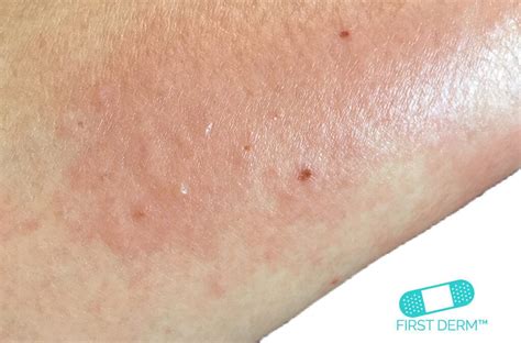 Online Dermatology Itchy Red Rash And Spots On Your Skin