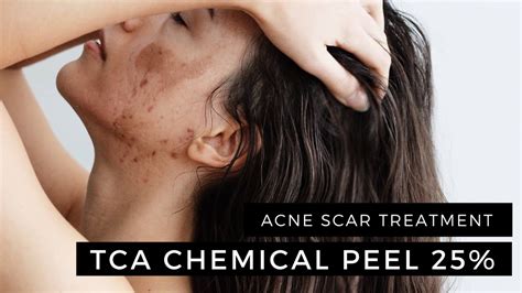 Enerpeel Tca Chemical Peel 25 2 Layers Acne Scar Treatment Youtube