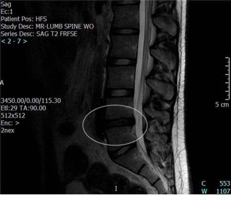 Joint pain, ankylosing spondylitis etc. Microdiscectomy: Spine Surgery for a Herniated Disc ...