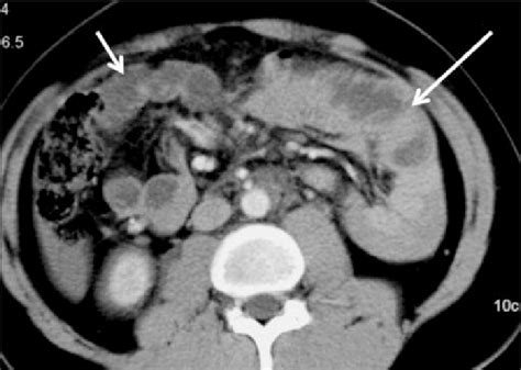Axial Ct Abdomen Showed A Focal Small Bowel Thickening With Abnormal