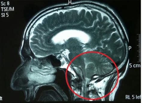 Mri Brain Showing Caudal Displacement Of Cerebellar Tonsils Through