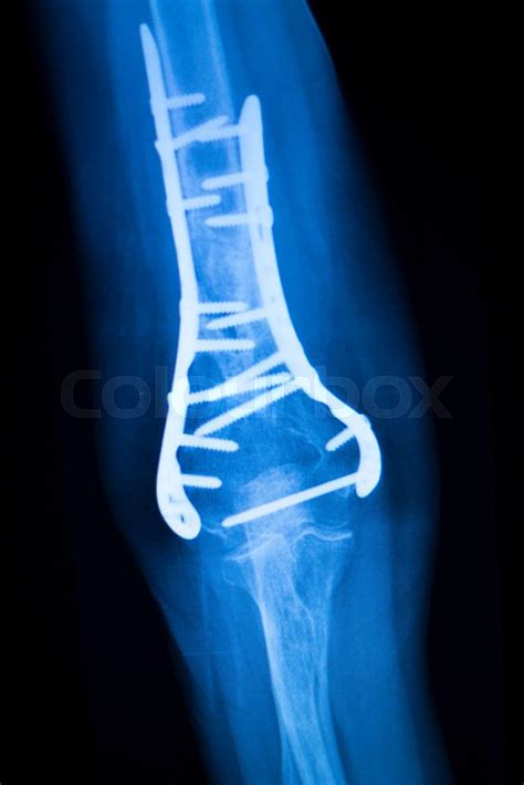 Surgical Implant Arm Elbow Xray Test Scan Stock Image Colourbox