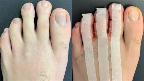 Toe Shortening Surgery Minimally Invasive Youtube