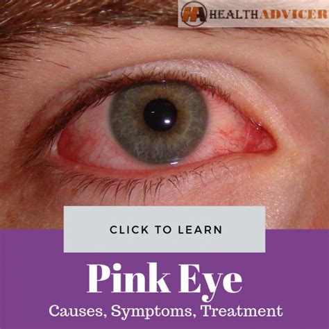 Pink Eye Causes Picture Symptoms And Treatment