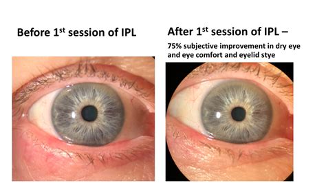 Intense Pulse Light Dry Eye Disease Treatment Glen Allen Va