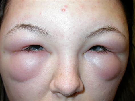 Conjunctivitis Allergic Infective Eye Surgery Ltd