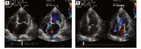 A So Called Organic Mitral Regurgitation Mr Mr Jet Is Eccentric