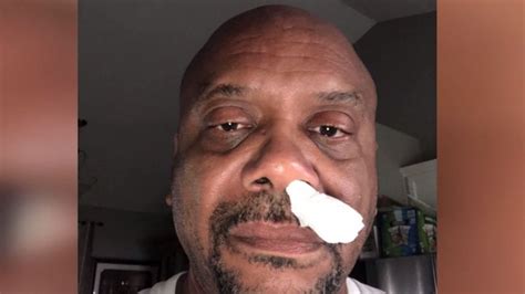 Man S Runny Nose Turns Out To Be A Leaking Brain