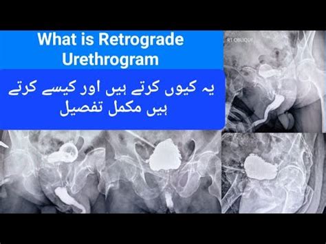 Retrograde Urethrogram Procedure How To Perform Retrograde