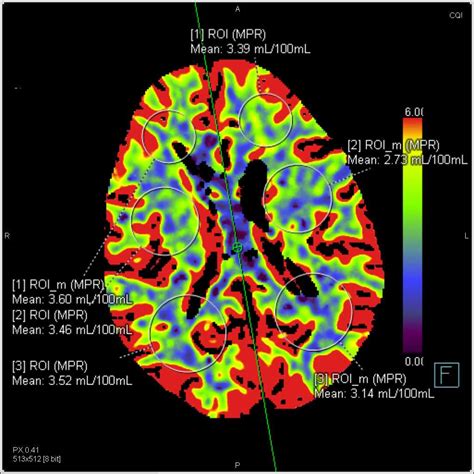 Perfusion Ct Of The Brain For Stroke Neuro Case Studies Ctisus Ct