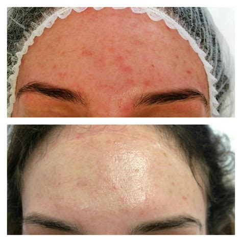Fractional face mesotherapy is considered a less traumatic treatment, so you can go about your business right after the procedure. Before & After