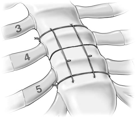 A Reinforced Sternal Wiring Technique For Transverse Thoracosternotomy