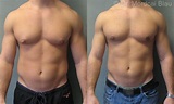 Bodybuilder Gynecomastia - Before and After Photos ⋆ Gynecomastia USA
