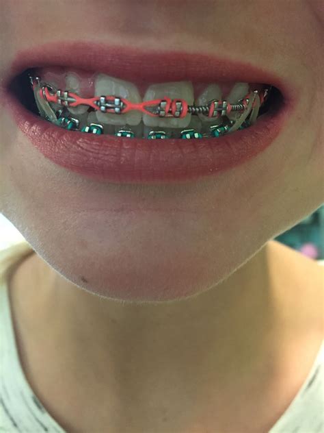 Pin By Alfredo Ciro On Braces Braces Teeth Colors Dental Braces