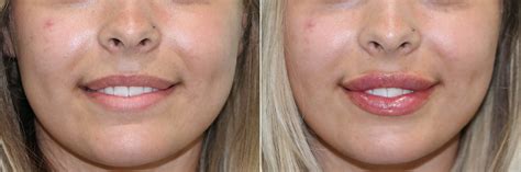 Lip Augmentation Photos Chevy Chase Md Patient 23015