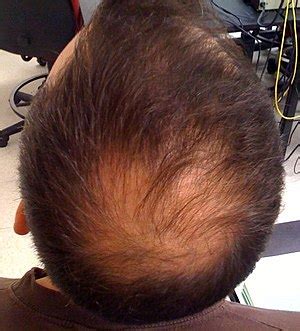 Interventions for female pattern hair loss. Pattern hair loss - Wikipedia