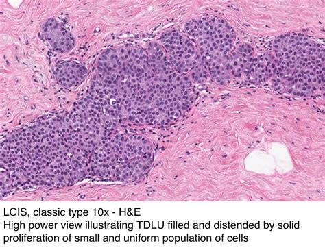 Pathology Outlines Lobular Carcinoma In Situ Lcis