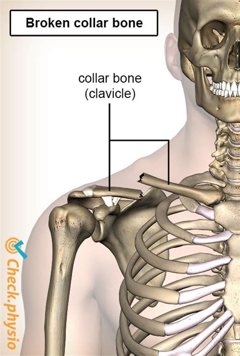 Broken Collarbone Physio Check