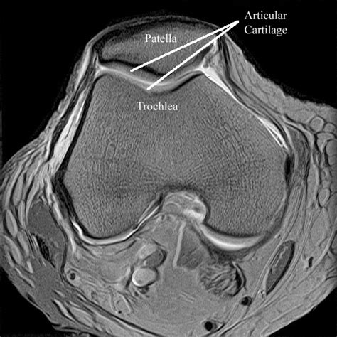 Radiology Anatomy Images Patellar Articular Cartillage In Mri Knee