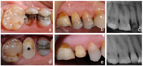 Ijerph Free Full Text Orthodontic Extrusion Vs Surgical Extrusion