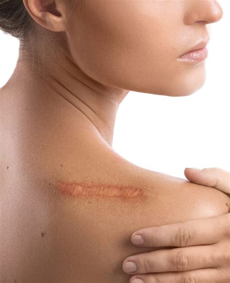 Scars Keloid Scarring And Scar Management Face Restoration Facial Aesthetics London Harley