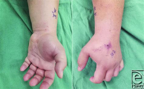 Case Report Compartment Syndrome Of The Hand Beware Of Innocuous