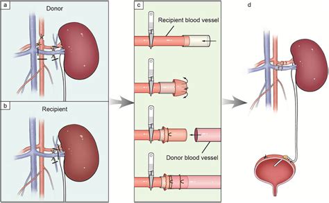 Diagrammatic Drawing Of Mouse Kidney Transplantation Procedures Using