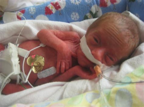 Login To Hubspot Preemie Stories Micro Preemie Preemie