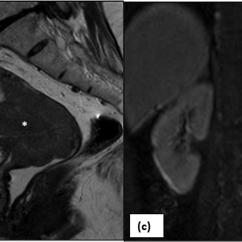 Ct In Stage Iva Of Carcinoma Cervix A Axial Ct Image Shows An