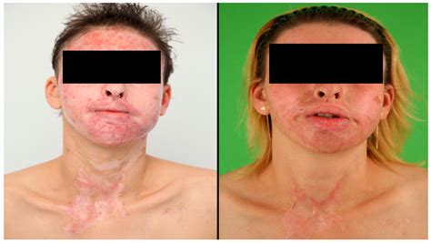 Jcm Free Full Text The Impact Of Facial Burns On Short And Long Term Quality Of Life And
