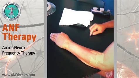 Patient With Radial Nerve Palsy Anf Therapy® Youtube