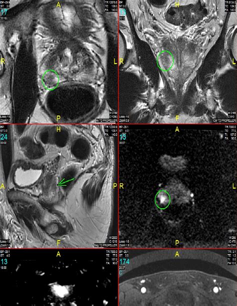 Prostate Mri Imaging East River Medical Imaging