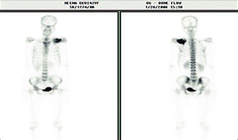 Technetium 99 Labelled Bone Scan Showing Intense Uptake Of Radiocolloid