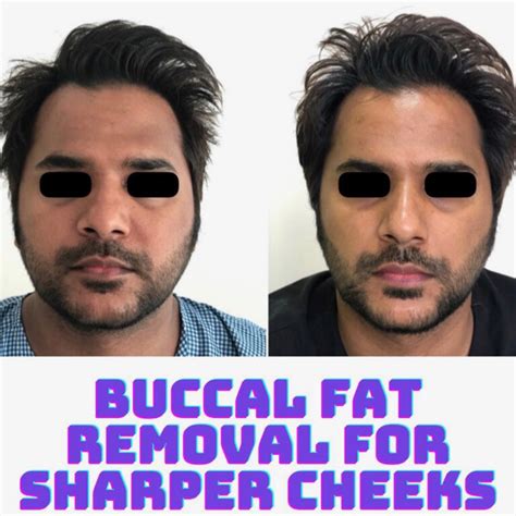 Cheek Buccal Fat Removal Best Plastic And Cosmetic Surgery Hospital