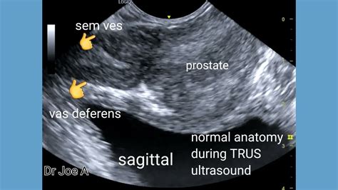 Normal Trus Transrectal Ultrasound And Doppler Anatomy Prostate Seminal Vesicles Ejaculatory