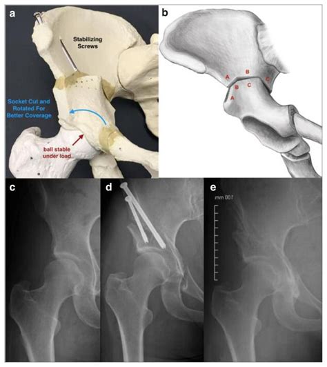 Hip Instability A Review Of Hip Dysplasia And Other Contributing