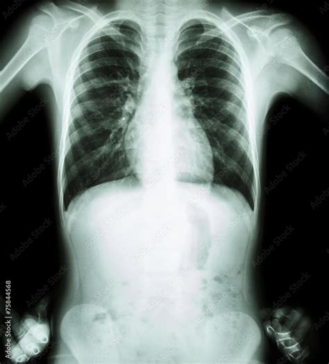 Normal Film Chest X Ray Akimbo Position Front View Royalty Free Stock